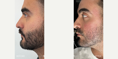 25-34 year old man treated with Fraxel Laser, CO2 Laser, Punch Excision - CO2 & Fraxel lasers remove skin layers to promote new growth, while punch excision physically removes scar tissue. The best option depends on scar type.