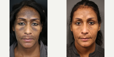 Regenerative Medicine for Pigmentation - PRP and microneedling for facial pigmentation.