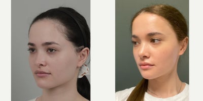 18-24 year old woman treated with Cheekbone Reduction, Forehead Reduction, Rhinoplasty, V Line Surgery - .