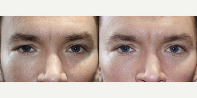 28 year old man treated with Blepharoplasty Surgery on upper Right eye - 28 year old man treated with Blepharoplasty Surgery on upper Right eye to correct drooping.