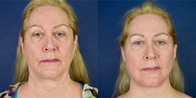 55-64 year old woman treated with Facelift Revision, Neck Lift, Eyelid Surgery - This is a before and after pictures on this female, who had a previous facelift.  She was worried about her wrinkled neck, fallen cheeks, jowls, dropping jawline. I performed a deep plane facelift, necklift, platysmaplasty, lower and upper blepharoplasty, lateral temporal browlift and facial fat grafting.