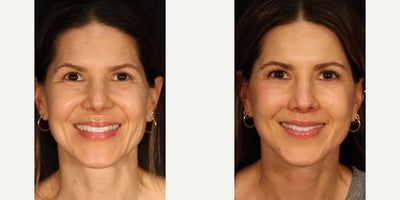 Woman treated with Neck Lift - She's 7 weeks out from facial rejuvenation surgery looking absolutely stunning...As you can see, this beautiful patient did not have significant jowling or deep wrinkles to begin with, and she's on the younger end of the facial rejuvenation demographic. But she wanted a change.This is becoming more and more common in my practice; younger patients (women in their late 30's or early 40's) consulting with me for facial rejuvenation. Surgical techniques for the face have improved dramatically over the past decade, allowing younger patients with relatively mild facial aging to achieve these types of results. Previously the techniques weren't powerful enough to generate a substantial outcome for younger patients. That is no longer true.For my patient I did an extended deep plane facelift and necklift, lip lift, and a subtle temporal lift. At this early stage she is still swollen and her incisions remain red but I'm already in love with this result. The best part is she still looks like herself.