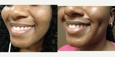 35-44 year old woman treated with Dimple Surgery - Timeless Dimple, Dimple Creation