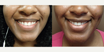 25-34 year old woman treated with Dimple Surgery - Timeless Dimple, Dimple Creation