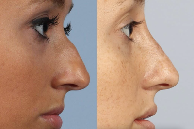 Nose filler for hump - Hyaluronic filler was used at the nasal radix to minimize the appearance of a dorsal hump due to a deep radix.