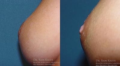 18-24 year old woman treated with Nipple Surgery - This 18 year old young woman had inverted nipples since puberty. She is seen before and after correction with minimally invasive technique.