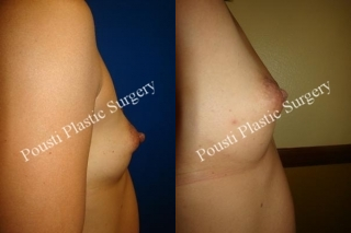  Nipple-areola Repair - This 36 year old female was interested in a nipple reduction procedure for quite some time. She was bothered by the size of her nipples both in and out of clothing and after research decided to have her nipple reduction performed.