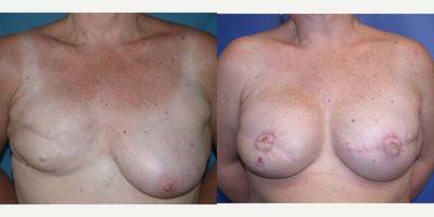 55-64 year old woman treated with Breast Reconstruction - Patient is a 57-year old Caucasian female, initially referred to me by her medical oncologist.  I initially saw patient in consultation regarding possible breast reconstruction options.  She had been recently-diagnosed with diffuse, high-grade DCIS of her left breast.  Of note, she had a history of intraductal carcinoma (ER (+)/ PR (+)) of the right breast for which she underwent a mastectomy with axillary lymph node dissection.  She had a lengthy breast reconstruction at that time using a right latissimus dorsi myocutaneous flap and small implant.  She had some type of operative revision of her breast reconstruction.  She denied receiving any radiation therapy. She then underwent left total mastectomy with axillary lymph node dissection, and I then performed immediate reconstruction with a submuscular Tissue-expander that was filled with 100 cc sterile saline.  She complained that her old right, reconstructed breast was too small and didn't look right.  At the same setting, I performed a revision of her right breast reconstruction that had developed severe capsular contracture and deformity, and was also much too small in size in comparison to patients left breast.  I approached the breast via an inframammary incision, performed Capsulectomy and Capsulotomies, and removed a small, smooth, round 90 cc silicone implant that was intact.  I then placed Alloderm and an Allergan Tissue Expander with a total fill-volume of 500 cc into the pocket and filled the expander with 70 cc of sterile saline.  She went on to heal well and had tissue expansion performed on an outpatient basis.  She then underwent Removal of her Tissue Expanders and Replacements with Allergan (Natrelle) silicone gel, Style 20 (high-profile) implants- 500 cc on the left side and a 550 cc on the right side. &nbsp;Finally, she had Bilateral Nipple-Areolar Reconstructions with local flaps and did not desire tatooing.&nbsp;