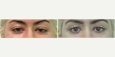 30+ year old woman treated with Upper Eyelid Surgery/Blepharoplasty - This young woman presented with the complaint of chronically tired looking and hooded upper eyelids. She stated that she had tried Botox and other neuromodulators but did not achieve the look she was hoping for.Her initial exam demonstrated higher-than-average hooding for a female in her early 30s. Upon further conversation, she stated that her mother also had heavy upper eyes and had a similar surgery for them when she was in her 40s.We decided together to perform an upper blepharoplasty. With some pre-op oral sedation with xanax, we performed the procedure with just local anesthesia in our office setting. Stitches were removed on post-op day 5 and she returned to work at the one week mark.Her results demonstrate a significant increase in the show of her eyelids which made her appear more awake as well as more youthful, while still keeping a natural appearance.