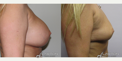 45-54 year old woman treated with Breast Implant Removal - 6 months after implant removal