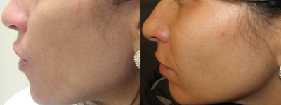 Isolaz treatment - 
	After one Isolaz treatment, most of the Hyperpigmentation is gone.
