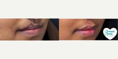17 or under year old woman treated with Cleft Lip And Palate Repair, Facial Reconstructive Surgery, Rhinoplasty - cleft lip reconstruction and scar revision with African saddle cleft nose reconstruction
