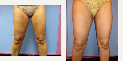 55-64 year old woman treated with Skintyte - Sciton Skintyte treated to thighs and knees