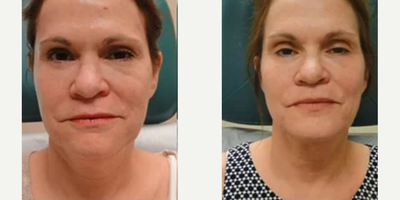 Woman treated with Infini RF - Woman treated with Infini RF