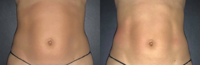 25-34 year old woman treated with CoolTone - 32 year old female treated her abdomen with four CoolTone sessions