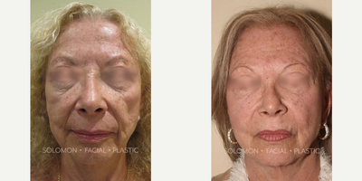 Bellafill - This female patient was treated with 8 syringes of Bellafill for the purpose of volume restoration. She was treated in the area of her naso-labial folds, cheeks, marionettes and tear troughs. This picture was taken 3 months post treatment.