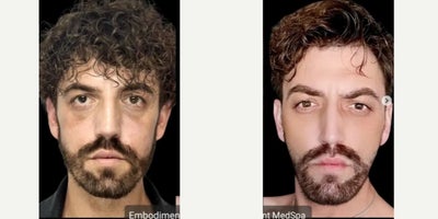 35-44 year old man treated with Radiesse, Sculptra - Radiesse was used to define the jawline and address the asymmetry in his chin. Sculptra was used to restore volume and collagen in the front of his cheeks.