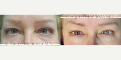 55-64 year old woman treated with PlasmaPen - This patient had plasma pen treatment to her upper and lower eyelids as well as crow's feet and glabellar. Plasma Pen treatments are a great way to keep your eyes looking fresh. As we age, our skin becomes lax and one of the first places to see it is the eyes. Plasma Pen is an option for patients whose eyes aren't yet ready for surgery or they don't want surgery. It's a fantastic way to stay ahead of aging.
