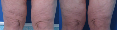 TriPollar - 
	Knee skin tightening after 10 treatments. Photos supplied by manufacturer, Pollogen Ltd, All Rights Reserved.
