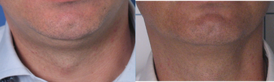 TriPollar - 
	Neck and double chin skin tightening after 4 treatments. Photos supplied by manufacturer, Pollogen Ltd, All Rights Reserved.
