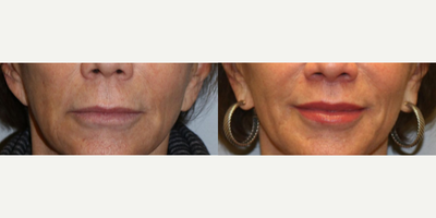 Woman treated with Lip Surgery - Woman treated with Lip Surgery through Lip Lift. She had lip flattening along with volume loss and less ability to see the pink lip. The contours were restored as well as improved the proportions.
