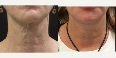 55-64 year old woman treated with Secret RF - 55-64 year old woman treated with Secret RF on the neck