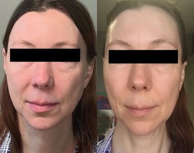 35-44 year old woman treated with TempSure Envi - This is after the 1st treatment. Most results will be seen 30 days after the treatments. Results best when doing TempSure 3-5 treatments (1 monthly) or if over 60, 6-7 treatments, 1 monthly.