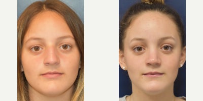 17 or under year old woman treated with Rhinoplasty, Septoplasty - A teenage patient, 1 year post-op rhinoplasty. This patient had a dorsal hump, bulbous tip, over-projected tip, and a drooping tip. Tip elevation, dorsal hump reduction, tip refinement, and nasal tip deprojection were performed. The overall goal is a conservative change of her nose to result in a natural appearance of the nose which does not droop when smiling and improves breathing.