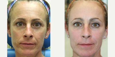 51 year old woman treated with Juvederm Voluma, Restylane, and Botox  (Liquid Facelift) - This patient was concerned with loss of volume in her cheeks and wrinkles setting in around her forehead, crows feet and glabella. She was treated with a combination of Juvederm Voluma, Botox, and Restylane.