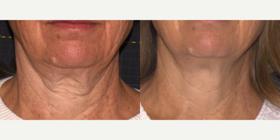 Woman treated with Sofwave - Photo provided courtesy of Sofwave, performed by Dr. Suzanne Kilmer, MD