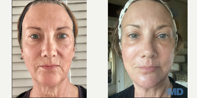 55-64 year old woman treated with NeoGen Plasma - This lovely patient received 1 high energy NeoGen treatment. Notice the dramatic improvement to her skin texture, tone and tightness! The patient is especially thrilled with the minimized wrinkles/fine lines around her mouth and the tightening on her neck.