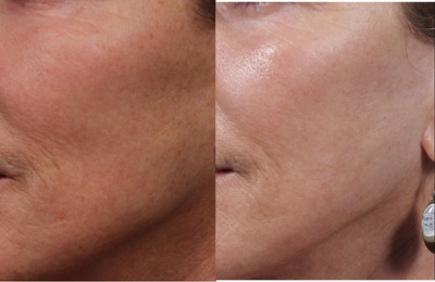 45-54 year old woman treated with Laser Resurfacing - 45-54 year old woman treated with Laser Resurfacing