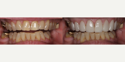 55-64 year old woman treated with Da Vinci Veneers, Porcelain Veneers - Female patient with a desire to change her smile, she was tired of discolored teeth and wanted to have a bright, better looking smile. We went ahead and completed our protocol utilizing our digital smile design software, she was happy with her proposal and our ceramist completed amazing results that transformed her smile just how she wanted. She is extremely happy with her results, we met and exceeded her expectations.
