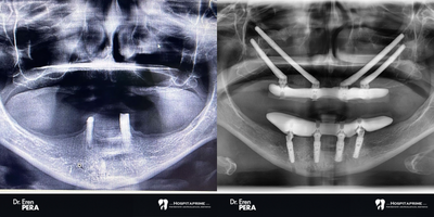 45-54 year old woman treated with All-on-4 Dental Implants, Dental Implants - zygomatic implants