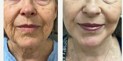 75 and up year old woman treated with Laser Resurfacing using TRL - 76 y/o woman, 3 months after one TRL laser treatment around the mouth.