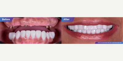 Woman treated with Dental Implants, All-on-4 Dental Implants, Smile Makeover - Woman treated with Dental Implants, All-on-4 Dental Implants, Smile Makeover