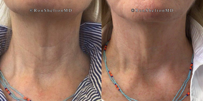 45-54 year old woman treated with Sofwave, Ultherapy, Skin Tightening - Improved horizontal neck creases 14 weeks post Sofwave and Ultherapy