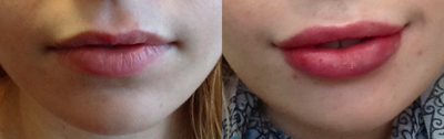 18-24 year old woman treated with Restylane - Restylane for lip enhancement.