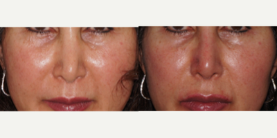 45-54 year old woman treated with Restylane to the nose and lips - patient s/p 3 previous rhinoplasties by a different surgeon, coming for eval and possible correction. Not interested in surgery. corrected nasal tip and midvault deviation as well as improved lip contour