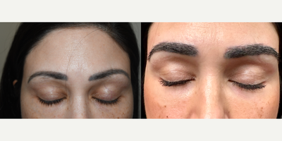 25-34 year old woman treated with Eyebrow Transplant - Result of 700 grafts to eyebrows