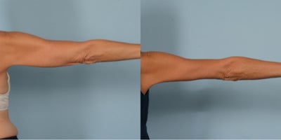 55-64 year old woman treated with Arm Lift - Brachioplasty