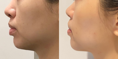 25-34 year old woman treated with Thermage FLX - age 25-34 years old woman treated with Thermage FLX 900 shots on lower face