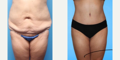 Woman treated with Butt Lift - Woman treated with Natural Butt Lift through fat transfer as well as Tummy Tuck