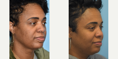 45-54 year old woman treated with Chemical Peel, Neo Laser, Laser Resurfacing - This patient received Aerolase, hydrafacials, botox, and LHR.