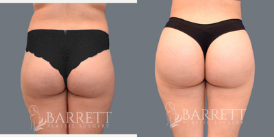 25-34 year old woman treated with Brazilian Butt Lift, Butt Lift - Brazilian Butt Lift: Liposuction of abdomen, flanks, and back with fat transfer to buttocksLiposuction: 750cc abdomen, 500cc flanks, 800cc backFat transferred in: 795cc each