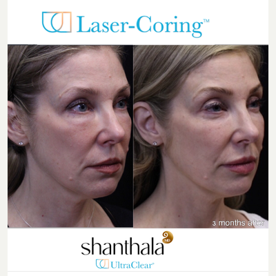 UltraClear Laser, Skin Rejuvenation, Laser Resurfacing, Fractional Laser by Dr. Shanthala - Laser-Coring with UltraClear laser after removal of under eye fillers resulted in peri-orbital rejuvenation, and fuller cheeks & more refreshed, youthful results performed by MD only.