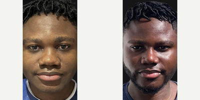 Man treated with African American Rhinoplasty - The difference between a well-defined nose and a bulbous one can be as small as 4 cm thats the length of rib cartilage we used to augment and sculpt the dorsum.For this patient, now 3.5 months post-op, we carefully diced and wrapped the cartilage in fascia, ensuring a smooth, natural appearance that blends seamlessly with his features.Through an open rhinoplasty, we utilized Piezo instruments for precision, slightly rasped the dorsum, and enhanced both the dorsum and tip with cartilage grafts to achieve this sharp, streamlined profile.