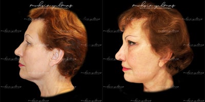 45-54 year old woman treated with Deep Plane Facelift, Neck Lift, Lip Lift, Brow Lift, Double Eyelid Surgery - This 55-64-year-old patient underwent a combination of Deep Plane Facelift, Neck Lift, Brow Lift, and Double Eyelid Surgery to achieve a refreshed and youthful appearance. The Deep Plane Facelift and Neck Lift focused on lifting and redefining facial and neck contours, addressing sagging skin and restoring a natural-looking structure. The Brow Lift elevated the brows, enhancing her overall expression with a more awake and vibrant look. The Double Eyelid Surgery refined the eye area, creating a balanced and rejuvenated appearance. At 1 month post-operative, the results already demonstrate significant improvement, with swelling continuing to subside and final results expected in the coming months.