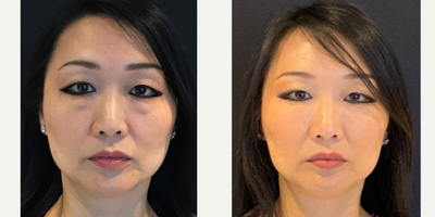 45-54 year old woman treated with Injectable Fillers - My 53 year old patient 2 weeks post Belotero and Dysport in the under eye area, as well as Dysport in the glabella lines and forehead and 1 syringe of Restylane Lyft in her cheeks. She also had a HydraFacial to imrpove the texture and tone and add hydration into the skin.