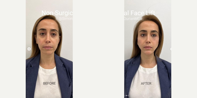 Woman treated with Nonsurgical Facelift, Dermal Fillers, Coolaser, Ultherapy, Secret RF - Treatment: Dr Simon Ourians Instant, Nonsurgical FaceliftPurpose: Reverse signs of agingHow it works: Using NEUSTEM injections, Ultrasound, and COOLASERResults: ImmediateNote: Individual results may varyTechnique: Micro-droplet injection, USRF, CoolaserAnesthesia: Topical numbing creamTime it takes: About an hourRecovery: NoneLasts: Months to years depending on the product usedCaution: Must be performed by an experienced providerPain level: Varies, none to mild